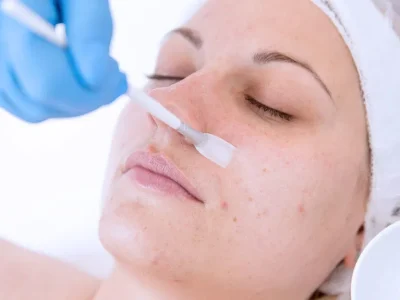 What to Do Before a Chemical Peel
